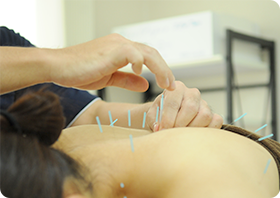 トリガーポイント鍼施術